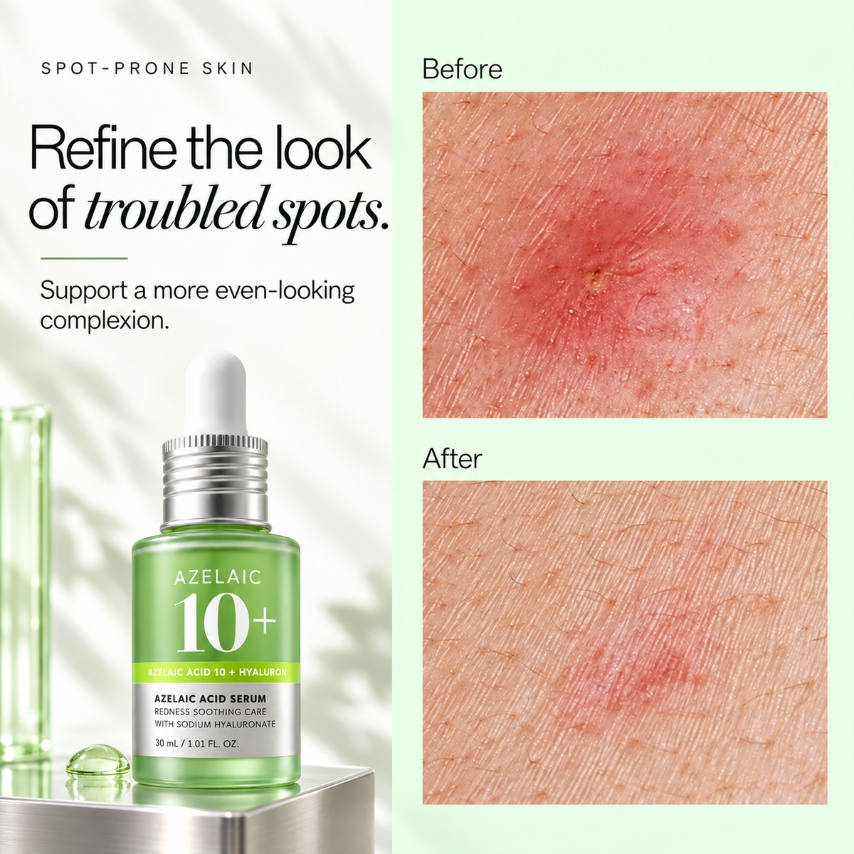 Azelaic Acid 10% + Hyaluronic Acid Soothing Serum, 30ml
